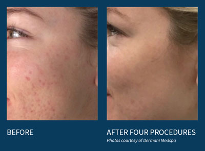 microneedling before and after