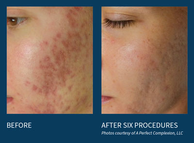 microneedling before and after