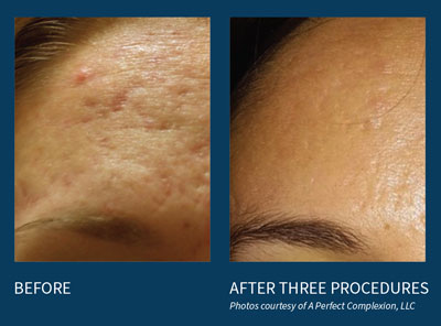 microneedling before and after