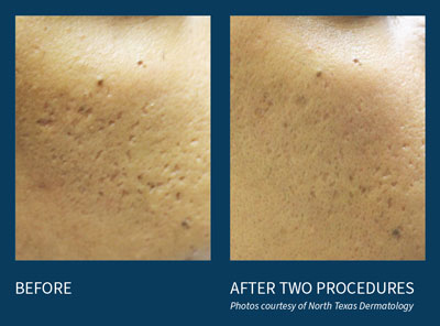 microneedling before and after