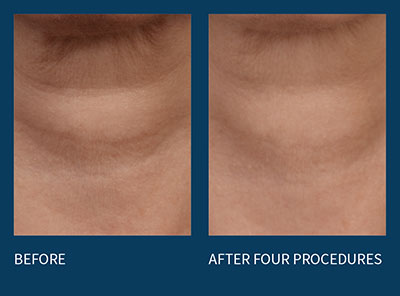 microneedling before and after