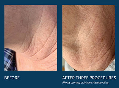 microneedling before and after