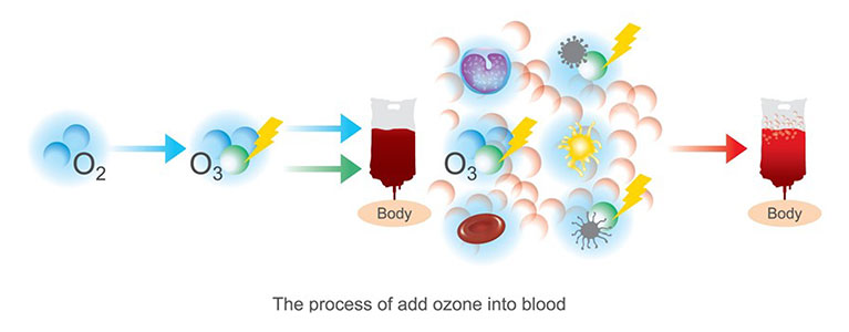 ozone therapy