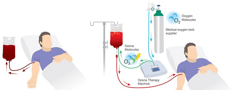 ozone therapy
