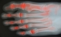 Rheumatoid Arthritis and the Benefits of Chiropractic Care